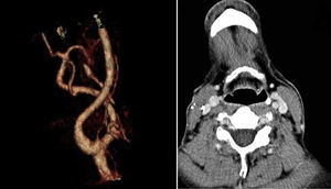 Angio-TC cervical. Corte axial en lado izquierdo y su reconstrucción en 3D en lado derecho donde se demuestran cambios posquirúrgicos en carótida común derecha. Todos los vasos del territorio carotídeo y vertebral se ven permeables y de calibre normal.