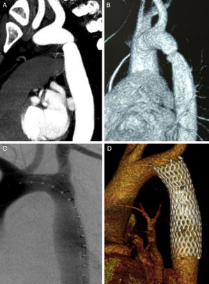 A) angio-TC preoperatorio. B) angio-RMN preoperatoria. C) Arteriografía intraoperatoria con stent desplegado. D) Reconstrucción volumétrica de angio-TC a los 24 meses del postoperatorio.