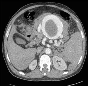 Tomografía axial computarizada, rotura de AAE con hematoma perilesional.
