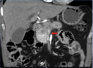 Imagen de la angio-TC que evidencia de infiltración de la vena mesentérica superior por el tumor.