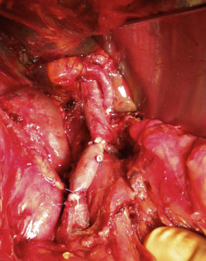 Imagen intraoperatoria del bypass portomesentérico con vena femoral superficial.