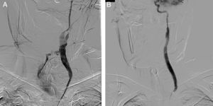A) Visualización de la fístula carótido-faríngea en la arteriografía. B) Control angiográfico posterior al implante de stent cubiertos desde la carótida común izquierda hasta la carótida interna.