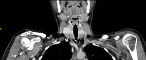 Angio-TC (sección coronal): aumento de la densidad grasa latero-cervical izquierdo.