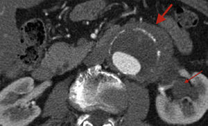 Angio-TC que muestra fibrosis periaórtica (flecha gruesa) e hidronefrosis (flecha fina) en paciente con aneurisma de aorta abdominal infrarrenal.
