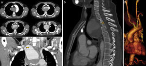a) Aneurisma de 8,5cm de diámetro máximo en origen de arteria subclavia derecha que sale distal a la salida de arteria subclavia izquierda, con desplazamiento anterior de tráquea y esófago; b) Desplazamiento de tráquea y remodelación de los cuerpos vertebrales D2-D3 (flecha); c) Estenosis de arteria subclavia derecha aberrante (flecha), y d) Reconstrucción tridimensional.