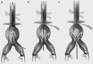 Utilización de balón de oclusión aórtica y diversas maniobras previas a explantación protésica.