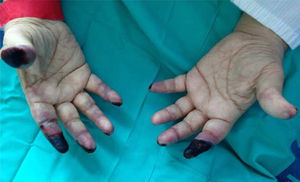 Lesiones isquémicas digitales tras 17 días de tratamiento en extremidades superiores: necrosis irreversible de falanges distales del segundo dedo bilateral, lesiones puntiformes en resto de dedos asociado a cianosis acra.