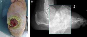 A) Úlcera con hiperqueratosis y necrosis por licuefacción periulceral. B) Imagen radiográfica de perfil en carga. Destrucción/fractura a nivel articulación de Lisfranc.