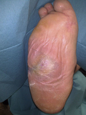 Úlcera cicatrizada tras 8 meses de tratamiento.