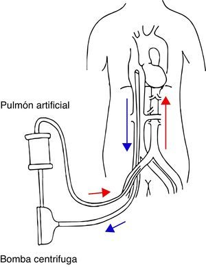 Esquema del funcionamiento del pECMO femorofemoral (flechas: sentido del flujo).