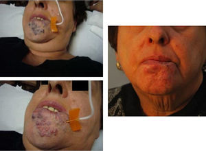 Paciente tratada en su juventud con radioterapia in situ que produjo una cicatriz en labio inferior. Se aprecia le extensa acción esclerosante por el cambio de color de los vasos rellenos de microespuma.