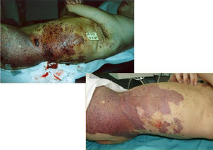 Malformación gigante inoperable, sangrado continuo que producía anemia severa. Estado antes y después de tratamiento.