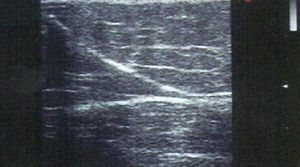 Paso de microburbujas a través de perforante de Hunter. La ecogenicidad de las burbujas permiten conocer desde su inicio este infrecuente atajo.
