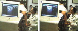 La ecografía se utiliza para confirmar que la flexión activa del pie cierra el segmento venoso intramuscular.