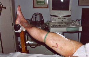 La ligadura detiene el flujo aferente desde la pierna y en casos identificados por el examen eco-Doppler previo impide la indeseada llegada del esclerosante al eje safeno y a las tributarias de la pierna.