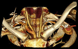 Reconstrucción 3D de angiotomografía computarizada tóraco-cervical que muestra el catéter colocado a nivel de la arteria subclavia izquierda.