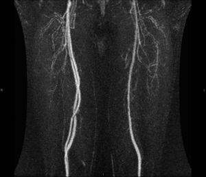 Angiorresonancia magnética de extremidades inferiores que muestra la presencia de arteria femoral superficial derecha doble.