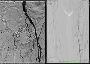 Arteriografía preoperatoria del miembro inferior derecho: hay una oclusión completa del eje iliofemoral con repermeabilización en arteria poplítea proximal.