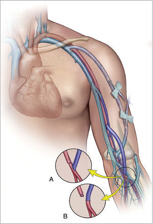 Representación gráfica de la revascularización distal con injerto venoso y ligadura intermedia de la arteria humeral (DRIL).