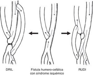 Diferenciación técnica entre el DRIL (distal revascularization with interval ligation) y el RUDI (revascularization using distal insertion).
