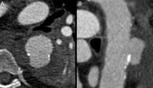 Úlcera aórtica penetrante en aorta torácica descendente vista en corte axial (A) y en corte sagital (B).