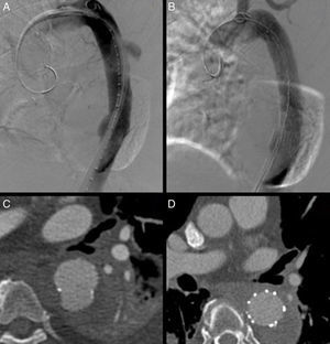 Úlcera aórtica penetrante en aorta torácica descendente tratada mediante colocación de endoprótesis torácica. Imagen angiográfica intraoperatoria (A y B) y de angio-TC (C y D) pre y posprocedimiento.