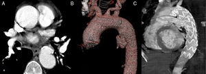 Reparación endovascular de una úlcera aórtica penetrante. Imagen de angio-TC preoperatorio (A) con reconstrucción tridimensional (B) y control postoperatorio (C).