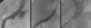 Rotura de arteria ilíaca intraprocedimiento (A) solucionada mediante colocación de stent cubierto (B). Nótese la importante ateromatosis y calcificación aorto-ilíaca (C).