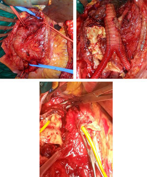 A-C) Intraoperatorio: A) Imagen de aorta y ramas viscerales. B) Disección y ambas arterias renales canalizadas. C) Bypass aorto bi-ilíaco con prótesis de Dacron® de 16×8mm más reimplante de la arteria renal izquierda.
