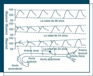 Cambio de la onda de presión de tronco aórtico y arterias periféricas en años 24, 54 y 68. Las flechas en las ondas señalan la primera inflexión sistólica correspondiente a la onda reflejada, que tiende a ocurrir antes según avanza la edad.