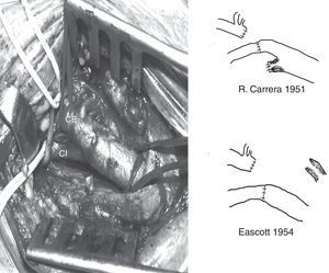 Se muestran las técnicas utilizadas por R. Carrera en 1951 y H.H. Eastcott en 1954.CE: carótida externa; CI: carótida interna.