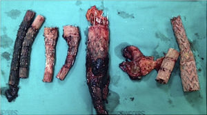 Endoprótesis abdominal y extensiones explantadas en el paciente número 4.