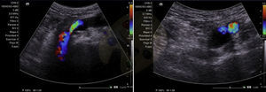 Eco-Doppler diagnóstico, corte longitudinal y transversal de vena femoral común con imagen anecogénica sugestiva de quiste.