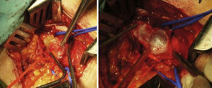 Imagen intraoperatoria en la que se aprecia el material mucoide y la resección del quiste de vena femoral común.