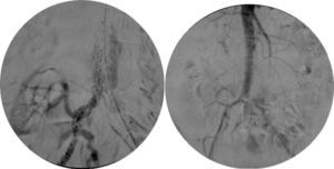 Implantación de endoprótesis aorto-bi-ilíaca (Endurant® II, Medtronic) a ambas ilíacas primitivas de forma proximal al injerto renal.