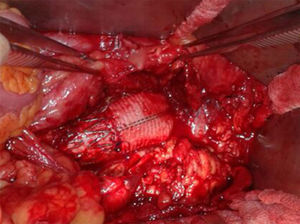 Resultado quirúrgico: bypass de Dacron® a endoprótesis previa.