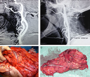 Resección de un tumor cervical gigante (carcinoma adenoide quístico). Arteriografía carotidea previa (A); y control post-stent en arteria carótida interna (B). Masa tumoral extirpada (C y D).