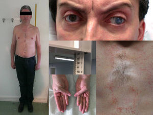 Rasgos fenotípicos del paciente: talla alta, alargamiento de huesos largos, pectus excavatum, hiperlaxitud ligamentosa, luxación de cristalino y estrabismo.
