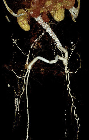 Angio-TC en la que se observa endoprótesis aorto-monoilíaca izquierda, bypass ilíaco-femoral izquierdo y bypass fémoro-femoral cruzado izquierdo-derecho expuesto.