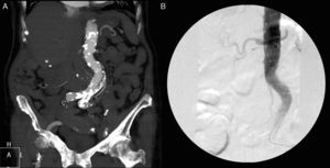 A) Angio-TAC urgente en el que se objetiva ateromatosis de grandes vasos y ausencia de renograma. B) Arteriografía intraoperatoria, no se aprecia la salida de las arterias renales.