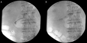 A) Arteriografía intraoperatoria. Canalización de arteria renal derecha. B) Stent de arteria renal derecha.