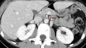 Corte axial mostrando distancia aorto-mesentérica disminuida.
