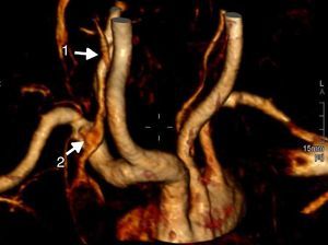 FAV carótida-yugular derecha. 1: punto de comunicación entre la arteria carótida común y la vena yugular interna derechas; 2: llenado de la vena yugular interna derecha en fase arterial.
