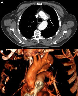 Angio-TAC con corte axial (A) y su reconstrucción en 3D (B), que muestra úlcera penetrante de aorta torácica con diámetro máximo de 29mm en la zona correspondiente al nervio laríngeo recurrente izquierdo.