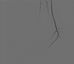 Arteriografía: obstrucción de tibial anterior supramaleolar, con ausencia de pedia y peronea.