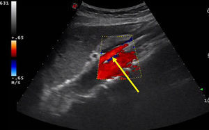 Atrapamiento de la vena renal izquierda entre aorta y arteria mesentérica superior, y ángulo aorto-mesentérico agudo.
