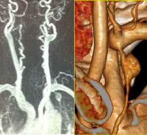 En la izquierda de la imagen se observa, además del aneurisma de la arteria mamaria interna, la tortuosidad de vertebrales y carótidas, con zonas de estenosis y dilataciones postestenóticas. A la derecha se observa una reconstrucción del aneurisma.