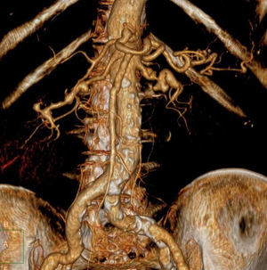 Reconstrucción de la angio-TC, donde vemos la imagen en «collar de perlas» (estenosis y dilataciones postestenóticas) de las arterias renales, típica de la displasia fibromuscular.