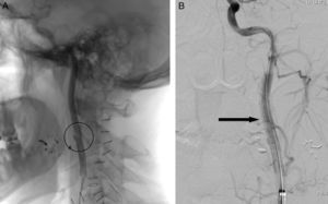 A) Arteriografía en la que aprecia imagen seudoaneurismática en ACI secundaria a contusión del proyectil. B) Prótesis endovascular colocada, (Tigris® de 6×40mm) (flecha).
