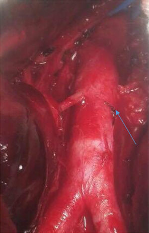 Aorta abdominal con lesión grado 2 en espejo, con reparación primaria (flecha).